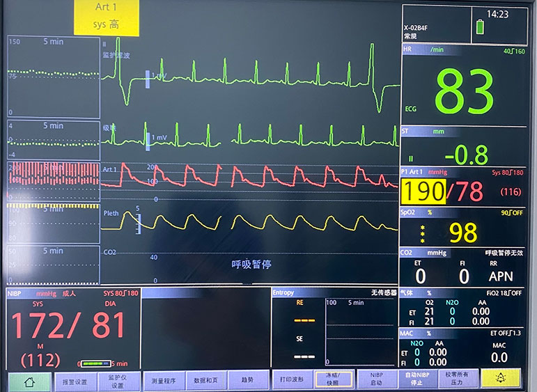 高龄患者术中频发室性心律失常处理