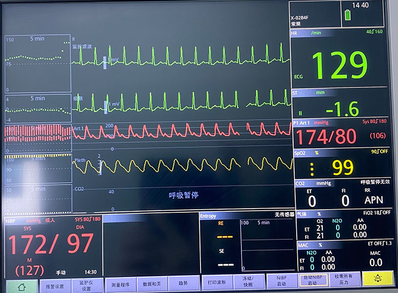 高龄患者术中频发室性心律失常处理