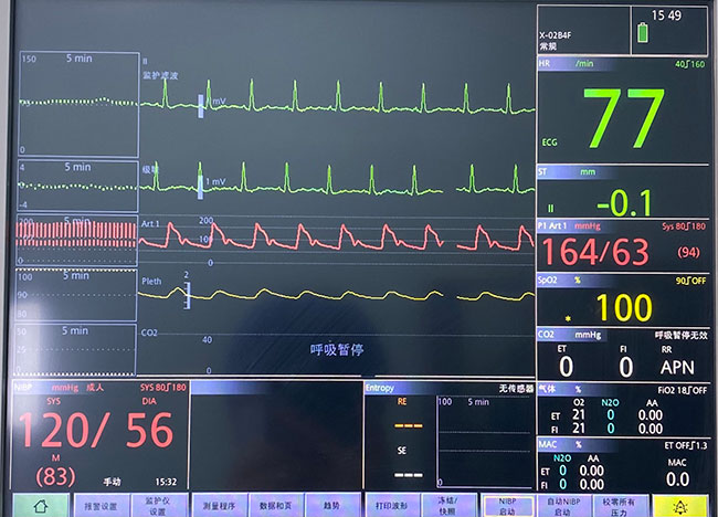 高龄患者术中频发室性心律失常处理